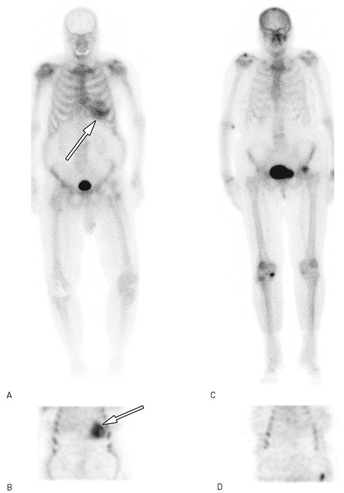 Figur 3  Scintigrafiunders&oslash;kelser med 99mTc-3,3-difosfono-1,2-propandikarboksylsyre (99mTc-DPD). Frontalt bilde (A) og&hellip;