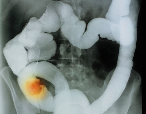 Illustrasjonsfoto Sciencephoto/NTB scanpix