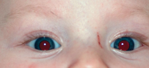 Figur 2  Normal r&oslash;d refleks p&aring; begge &oslash;yne