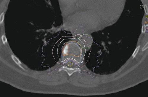 Figur 2  Eksempel p&aring; en doseplan ved stereotaktisk str&aring;ling. Str&aring;lingsdosen som gis innenfor den lilla linjen er 8 Gy eller&hellip;