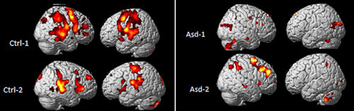 Bildet viser lokalisering i hjernen av fMRI-respons hos to friske barn (Cntrl-1, Cntrl-2) og to barn med autismediagnose &hellip;