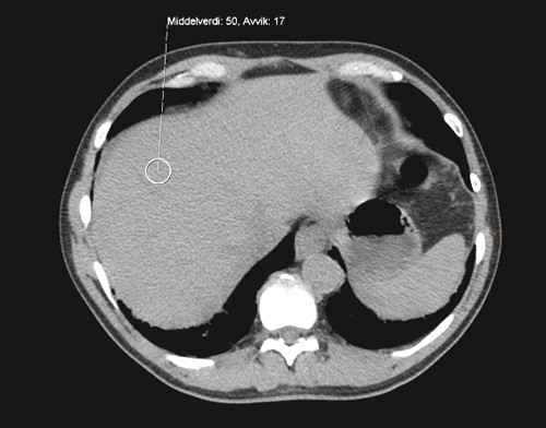 Figur 2  CT abdomen uten kontrastmiddel fra pasient uten patologiske forandringer