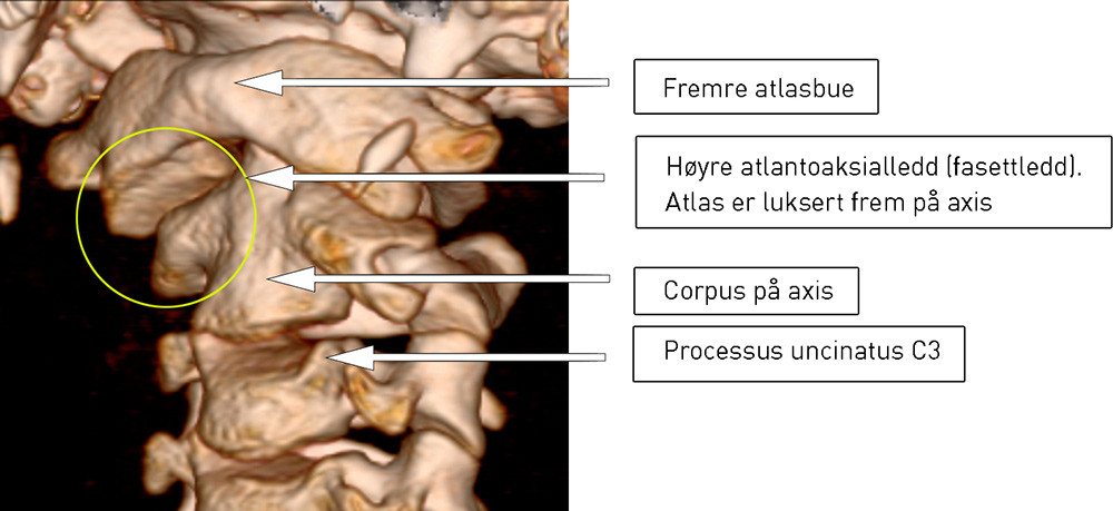 Figur 1  Subluksasjon av h&oslash;yre atlantoaksialledd, sett fra venstre side/forfra