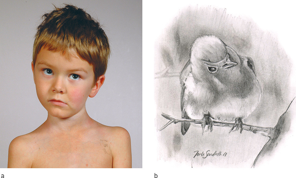 Figur 2  a) Cock robin-feilstilling, benevnt slik fordi den kan likne r&oslash;dstrupens stilling n&aring;r den lytter etter mark (b)&hellip;