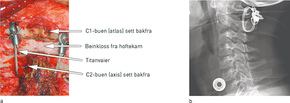Figur 3  C1- og C2-buen fikseres til hverandre med st&aring;ltr&aring;d eller titanvaier p&aring; begge sider og beinkloss fra pasientens&hellip;