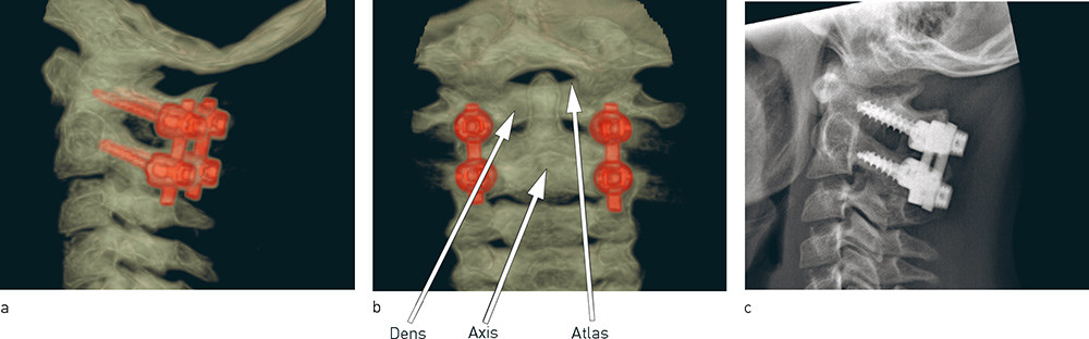 Figur 4  Atlas og axis er fiksert med skruer og stag p&aring; begge sider (Harms teknikk). CT-bilder fra a) siden og b) bakfra &hellip;