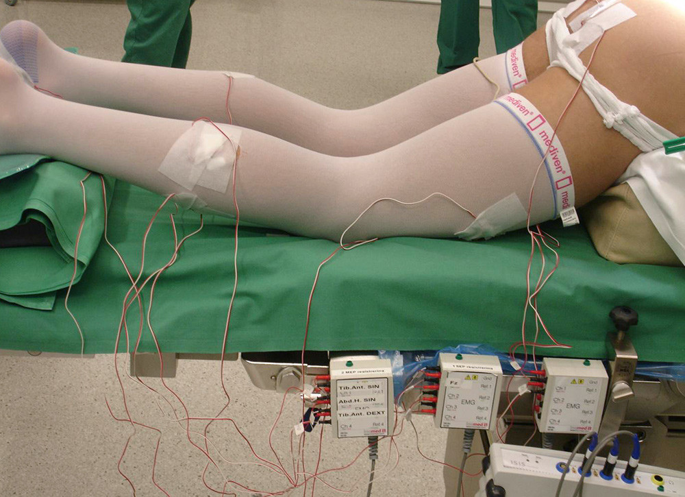 Figur 1  Monitorering hos en pasient med tethered cord-syndrom. Ved hjelp av n&aring;leelektroder m&aring;les signaler bilateralt fra m&hellip;