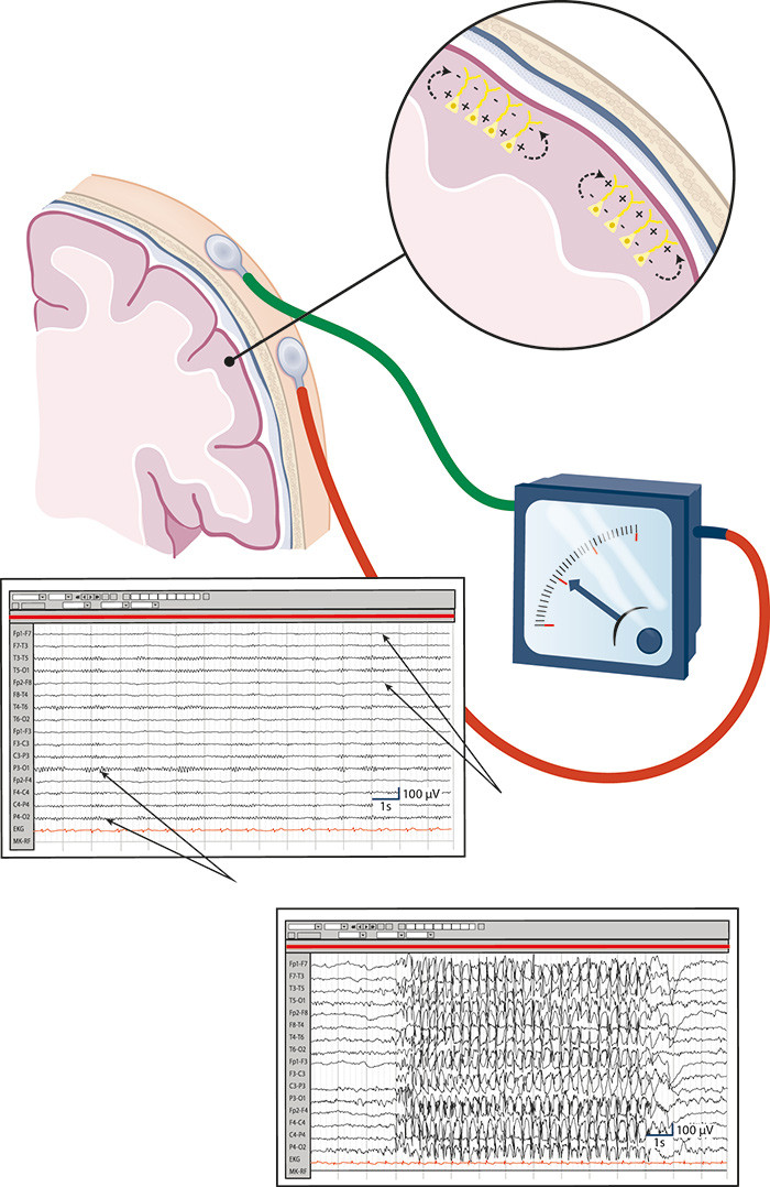 Ved EEG registreres elektrisk aktivitet som genereres av ekstracellul&aelig;re ionestr&oslash;mmer rundt pyramidecellene i hjernebarken&hellip;