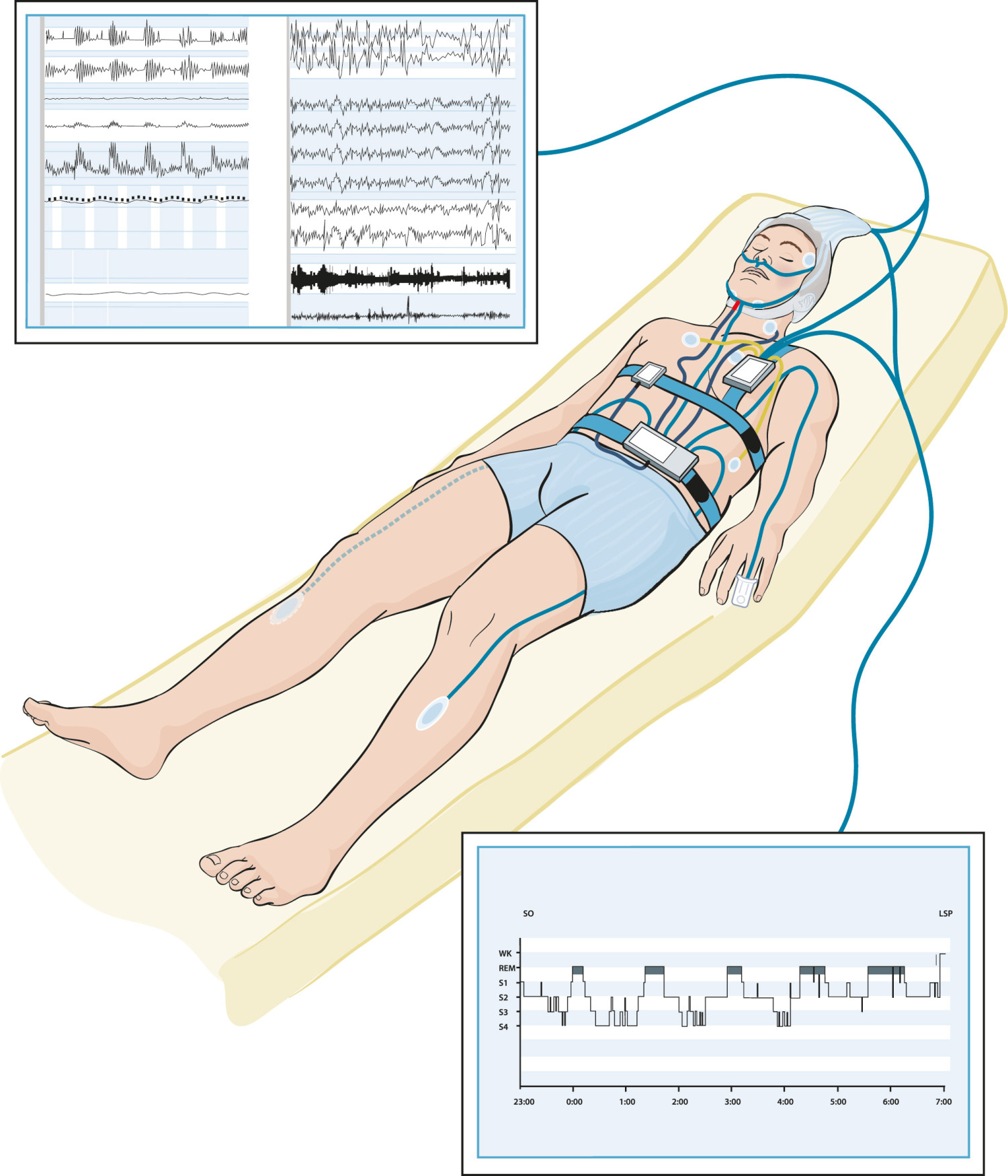 Vanlig plassering av elektroder og annet registeringsutstyr ved polysomnografi. &Oslash;verste panel viser respirasjonsvariabler&hellip;