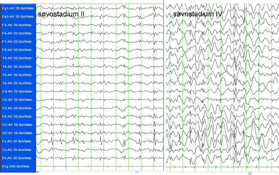Figur 2  Barn i skolealder, uten epilepsidiagnose, henvist for l&aelig;re- og konsentrasjonsvansker. Ambulatorisk 24 timers- EEG&hellip;