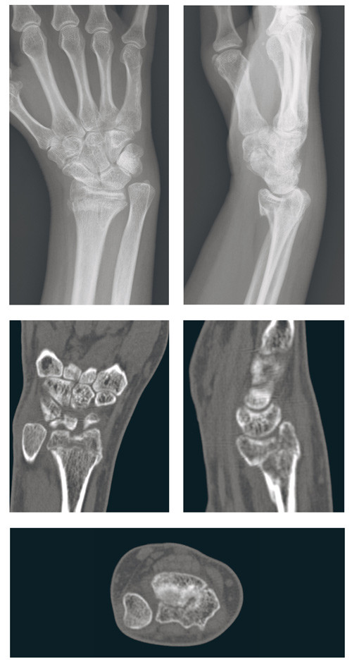 Figur 1  R&oslash;ntgenologisk resultat etter konservativt behandlet ustabil distal intraartikul&aelig;r radiusfraktur hos pasient i 40&hellip;