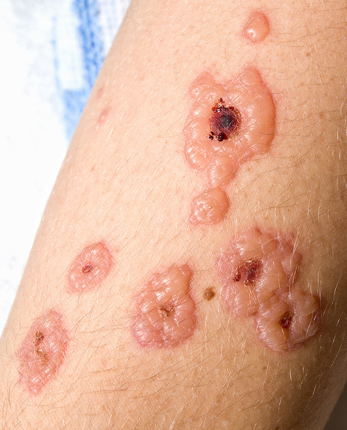 Figur 2  Det f&oslash;rste d&oslash;gnet etter innleggelsen endret utslettet karakter til multiple bull&oslash;se kokardelesjoner av varierende&hellip;