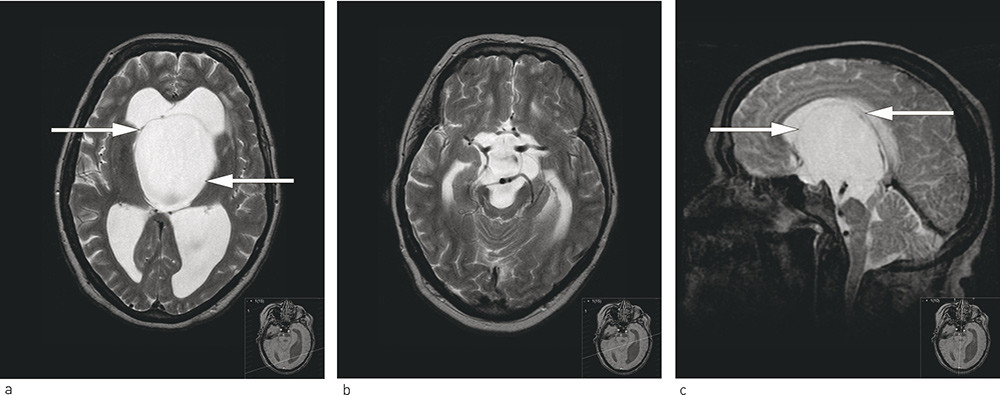 Figur 1  T2-vektet MR caput tatt under f&oslash;rste innleggelse. a) Aksialt snitt p&aring; h&oslash;yde med sideventriklene viser ballonerte&hellip;