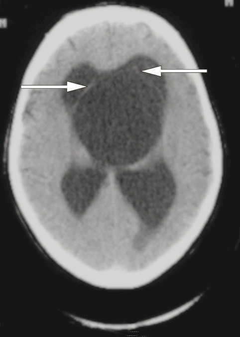 Figur 3  CT caput utf&oslash;rt ved lokalsykehus 15 &aring;r f&oslash;r innleggelse hos oss viste obstruktiv hydrocephalus. Araknoidalcysten var&hellip;