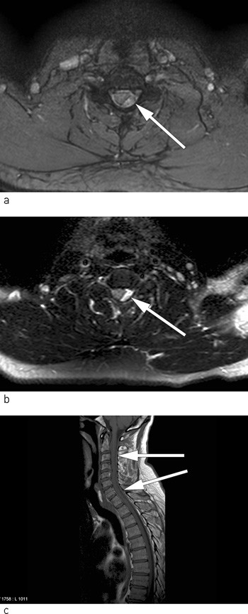 Figur 2  Epiduralt hematom med masseeffekt p&aring; ulike MR-sekvenser a) og b) aksiale snitt og c) sagittalt snitt, litt&hellip;