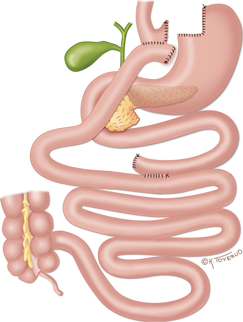 Figur 1  Gastrisk bypass. I Norge anlegges rutinemessig det aliment&aelig;re l&oslash;pet antekolisk (foran colon). Man slipper da &aring; lage&hellip;