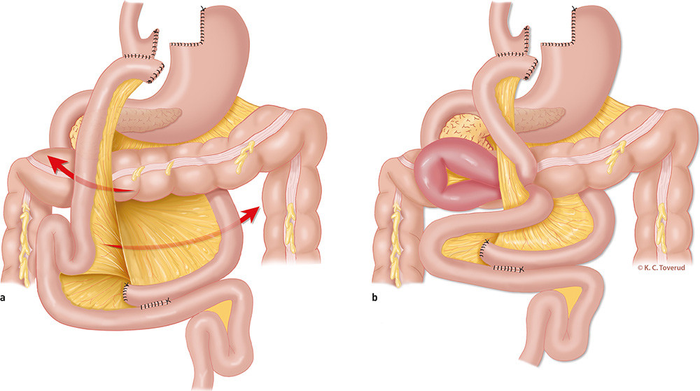 Figur 2  Herniering av tarm. a) Typiske lokalisasjoner for herniering etter antekolisk gastrisk bypass. Den &oslash;vre pilen viser&hellip;