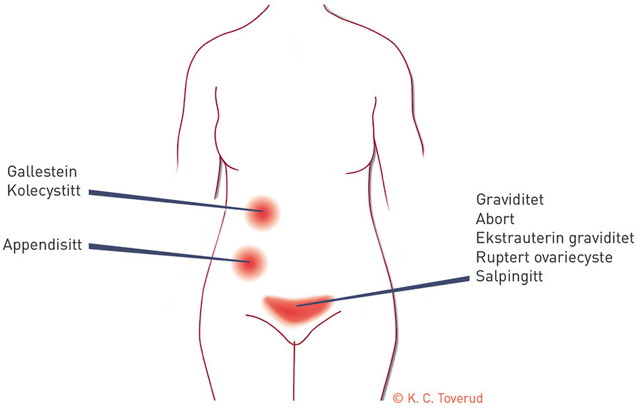 Figur 1  Typisk smertelokalisering for differensialdiagnoser som ble vurdert hos pasienten