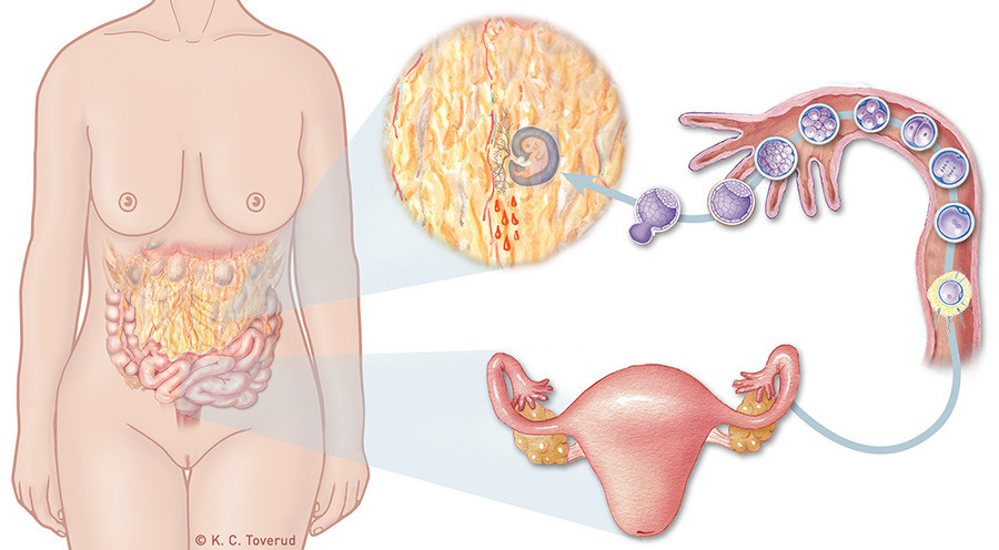 Figur 4  Illustrasjon av sekund&aelig;r implantasjon p&aring; omentum majus