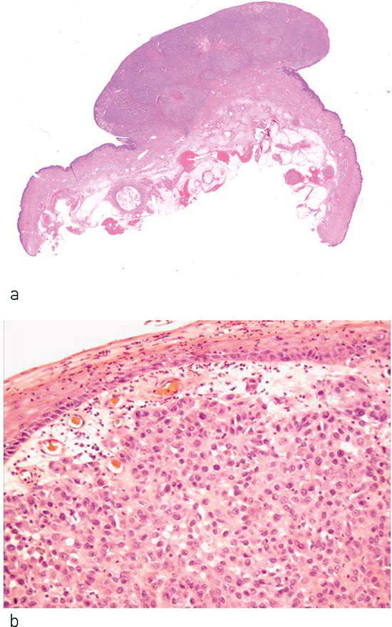 Figur 1  a) Polyp&oslash;st malignt melanom av nodul&aelig;r subtype, b) Diffus (udifferensert) vekst av grovt atypiske celler, assosiert&hellip;