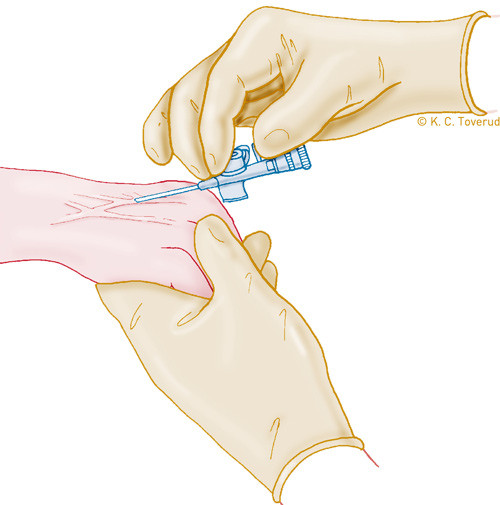 Innsetting av venekateter. Illustrasjon &copy; K. Toverud