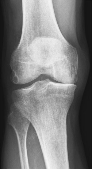 Artrotisk kne. Foto Volda sjukehus