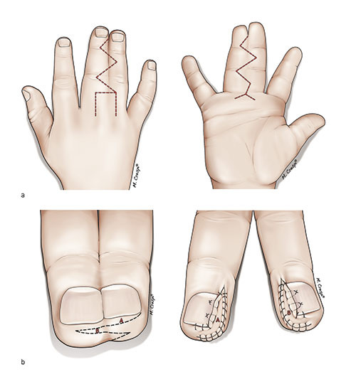Figur 3  Eksempel p&aring; plastikk for deling av syndaktyli mellom lang- og ringfinger. a) Planleggingstegning fra volar- og&hellip;