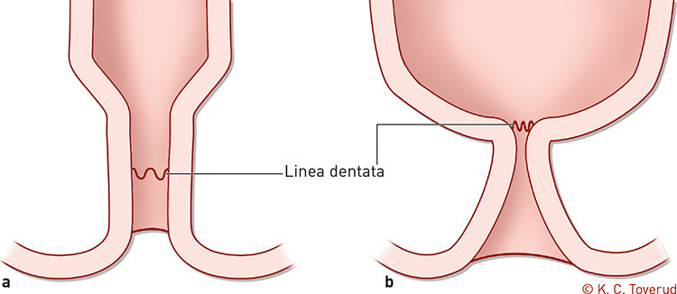 Figur 2   a) Normal analkanal. b) Traktformet analkanal opp til stenose i niv&aring; med linea dentata &ndash; karakteristisk funn ved&hellip;