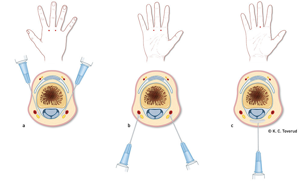 Figur 1  Digital blokade kan settes fra a) dorsalsiden eller b) volarsiden med 1&thinsp;&ndash;&thinsp;1,5 ml lidokain med adrenalin p&aring; hver&hellip;