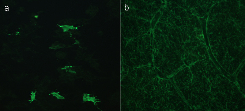 Figur 2  a) Antistoff i serum fra pasient med neuromyelitis optica som farger transfekterte akvaporin-4-celler, og b)&hellip;