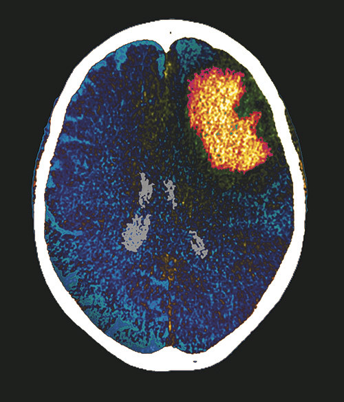 Illustrasjonsfoto Science Photo Library/NTB scanpix