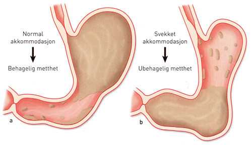 Figur 1  Magesekkens akkommodasjon og dens betydning for metthet. a) Ved normal akkommodasjon relakseres den &oslash;verste delen&hellip;