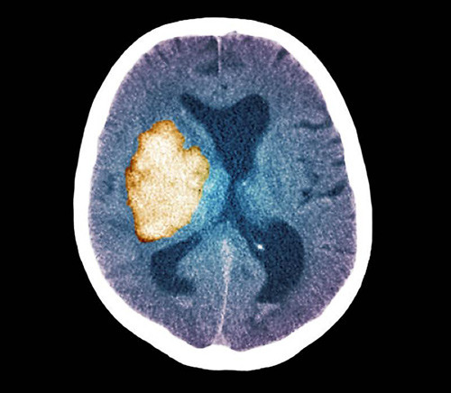 Illustrasjonsfoto Sciencephoto/NTB scanpix