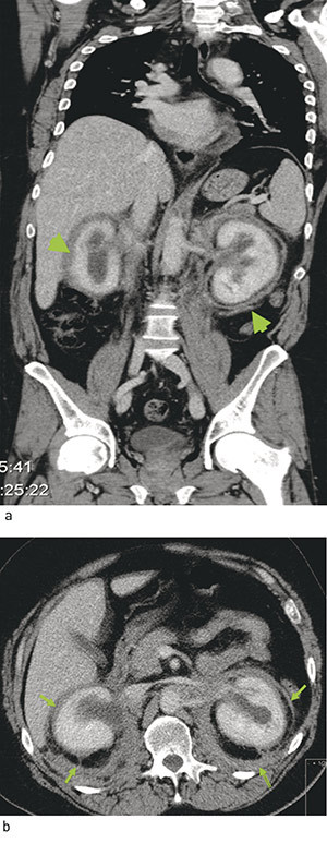 Figur 2  CT abdomen med &laquo;hairy kidneys&raquo;. a) frontalsnitt, b) tverrsnitt