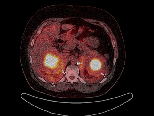 Figur 3  18FDG PET-skann viser &oslash;kt opptak i perirenalt vev og &laquo;hairy kidneys&raquo;