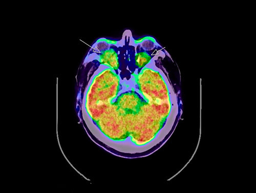 Figur 4  Retrobull&aelig;re oppfyllinger i 18FDG PET-CT
