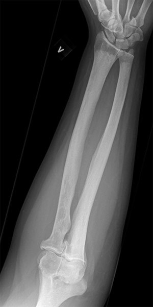Figur 5  Symmetrisk utbredt sklerose i diafyser og metafyser og utsparing av epifysene i radius og ulna