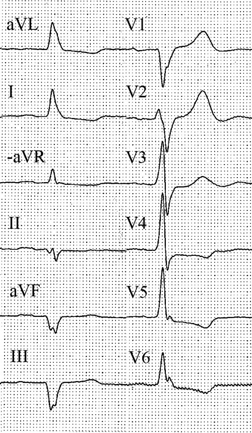 Figur 1  Pasientens EKG ved unders&oslash;kelse hos kardiolog. 50 mm/s. Det ses sinusrytme med patologiske Q-takker i nedre vegg,&hellip;