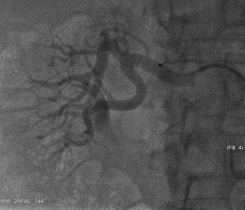 Figur 1  Angiografibilde som viser ablasjonskateter i h&oslash;yre nyrearterie. Fra angiografilaboratorium ved Oslo&hellip;