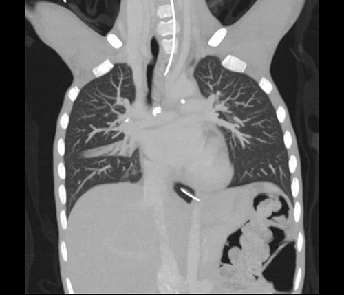 Figur 1  Forkalkede lymfeglandler i det aortopulmonale vindu