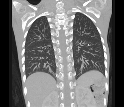 Figur 2  Suspekt prim&aelig;rfokus (Gohns fokus) basalt i venstre overlapp