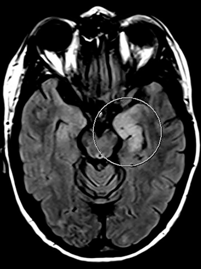 Figur 2a  MR caput med aksial FLAIR tatt under den aktuelle episoden med hjerneaffeksjon, viser signalforandringer i venstre&hellip;