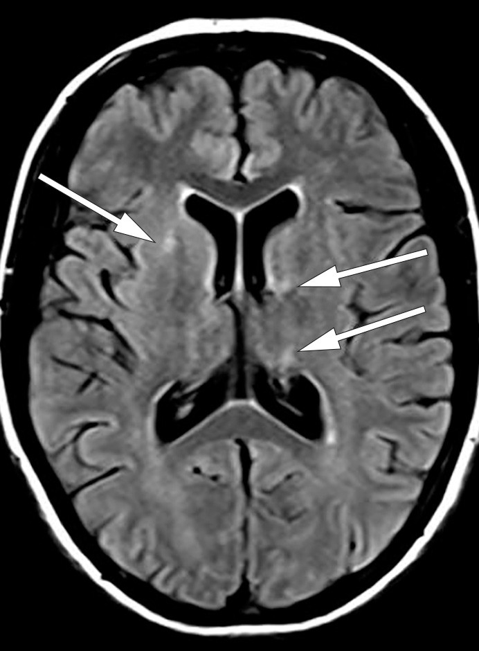 Figur 2b  MR caput med aksial FLAIR viser h&oslash;ysignalforandringer i fremre bein av h&oslash;yre capsula interna og i venstre caput&hellip;