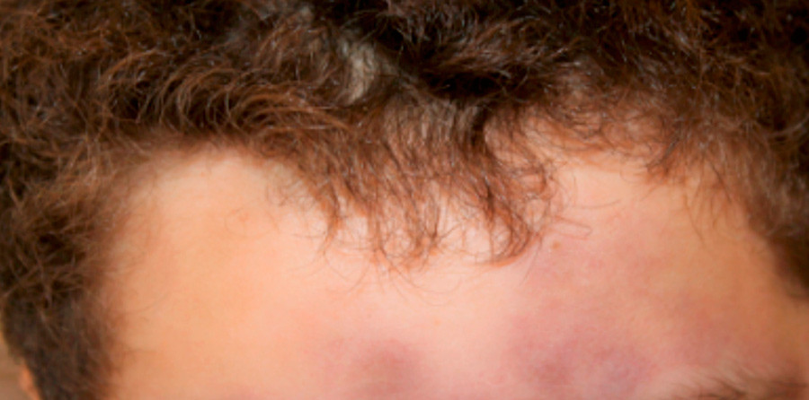 Figur 1  Bl&aring;lig utslett i pannen