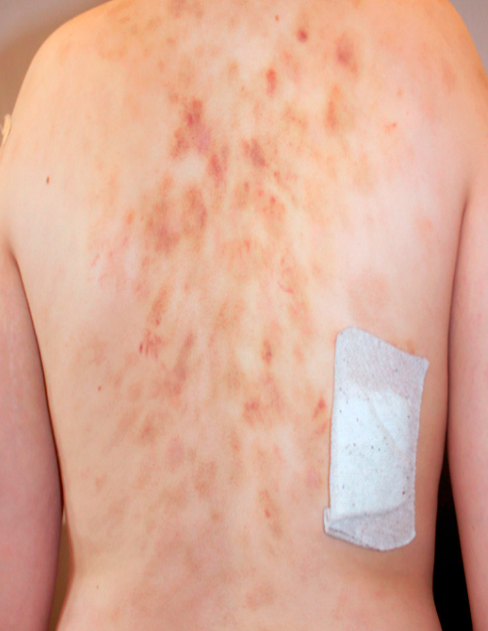 Figur 2  Utbredt utslett med brune og svakt bl&aring;fiolette lesjoner av ulik st&oslash;rrelse spredt p&aring; hele ryggen, enkelte med&hellip;