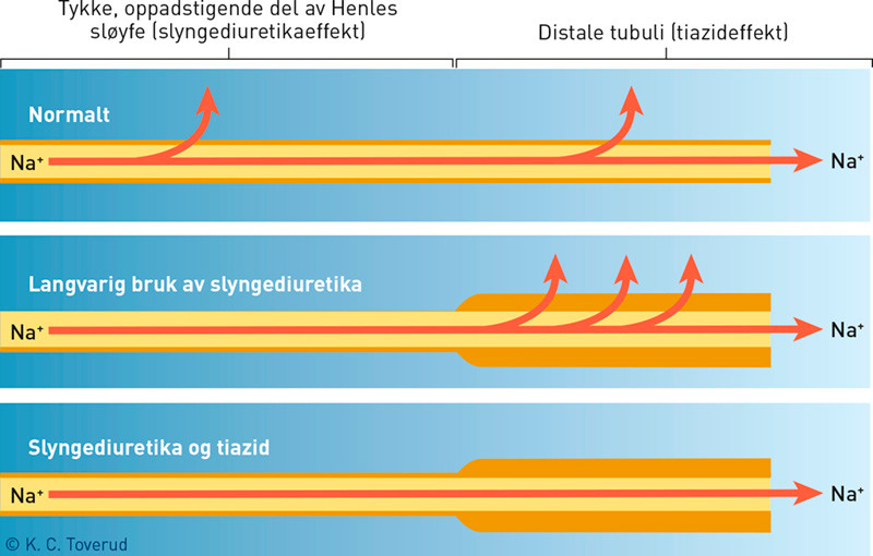 Figur 3  Mekanisme for synergistisk respons p&aring; kombinasjon av slyngediuretikum og tiazid. Langvarig behandling med&hellip;