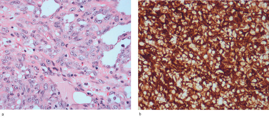 Figur 2  a) Mikroskopisk unders&oslash;kelse viste karstrukturer kledd av atypisk endotel, forenlig med angiosarkom (hematoksylin-&hellip;