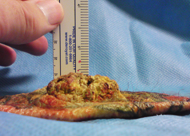 Figur 2  Eksidert vev, inkludert tumor