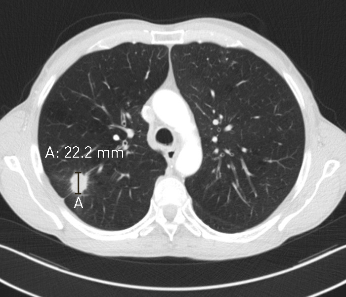Figur 1  CT-bilde ved f&oslash;rste unders&oslash;kelse