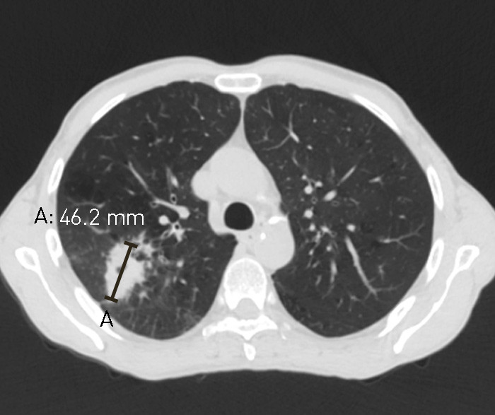 Figur 2  CT-bilde 2 1/2 m&aring;ned senere